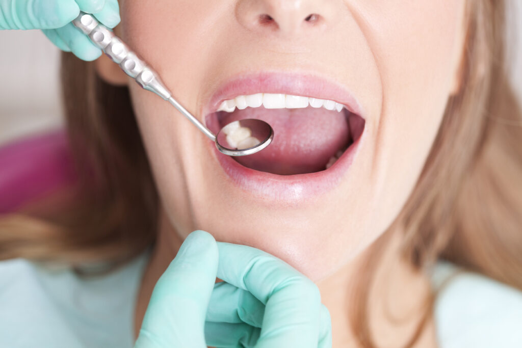 Removing Amalgam Fillings